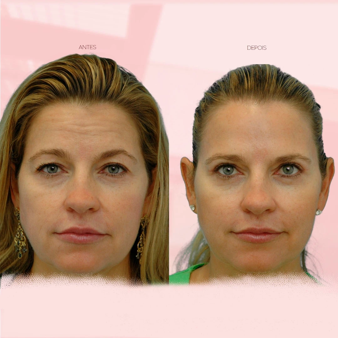 antes-depois (1)