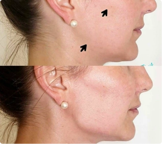 Tratamento de contorno facial e papada (1)