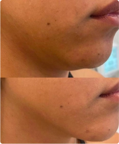 Tratamento de contorno facial e papada