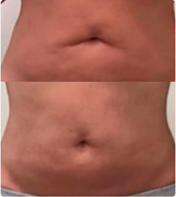 Tratamento para quebra de gordura e flacidez