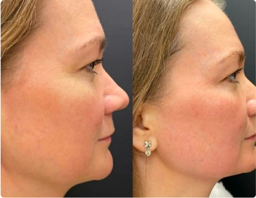 tratamento para contorno facial e contra derretimento da derme