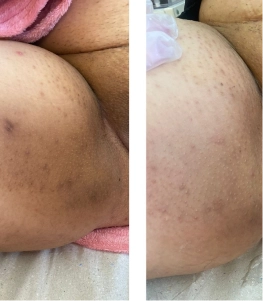 1- Antes e depois botox (1) (1)