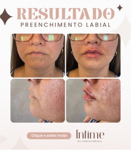 1- Antes e depois botox (1)
