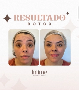 1- Antes e depois botox (2)