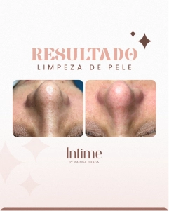 2- ANTES E DEPOIS LIMPEZA DE PELE (1)